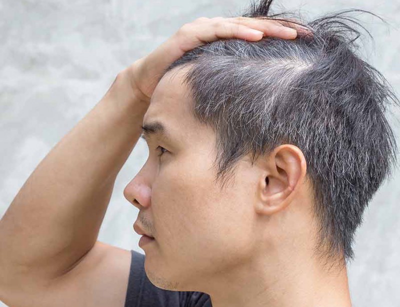 7 nguyên nhân khiến người trẻ có tóc bạc