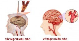 Điều trị tai biến mạch máu não
