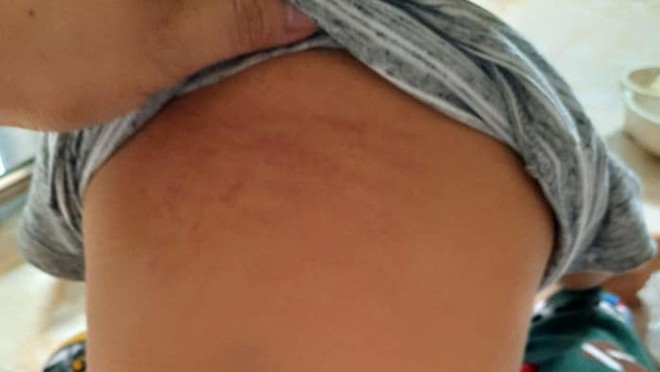 Cô giáo mầm non bị tố dúi đầu trẻ 15 tháng vào bồn cầu