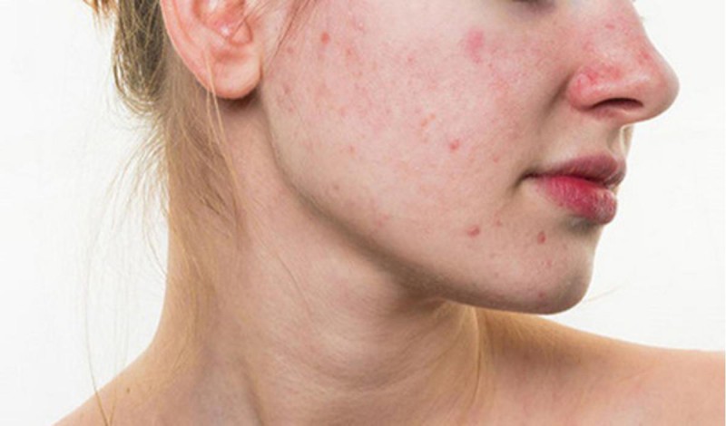 Tác dụng phụ thường gặp sau điều trị sẹo rỗ