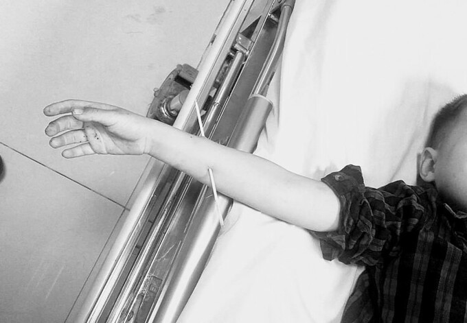 Đùa nghịch sau khi ăn, bé trai bị que xiên thịt đâm xuyên cẳng tay