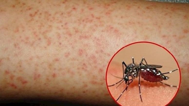 Bệnh viện TP.HCM phải kích hoạt báo động đỏ khi có ca sốt xuất huyết nặng