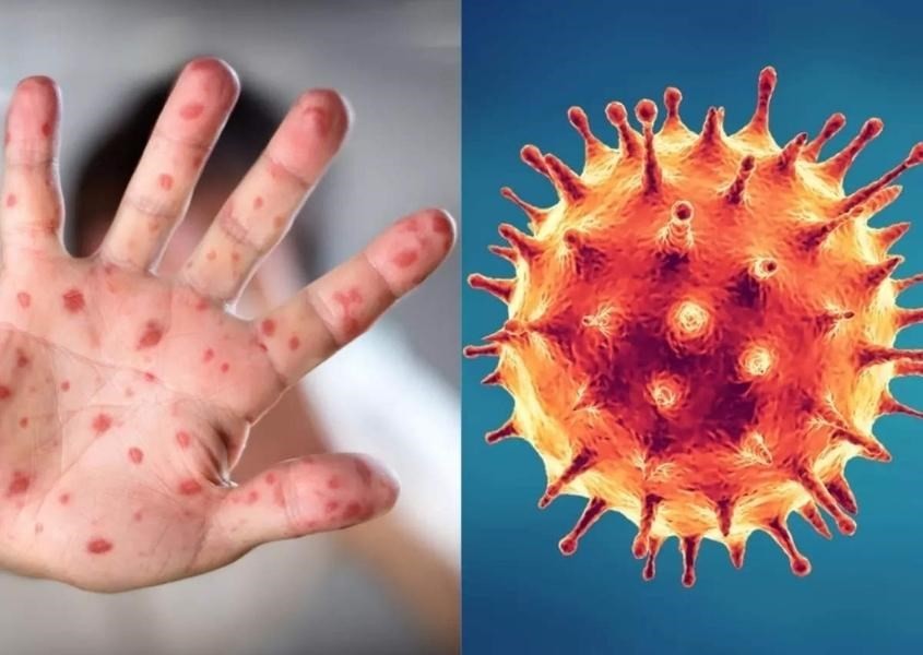 Ghi nhận ca nghi mắc đậu mùa khỉ tại Đắk Lắk