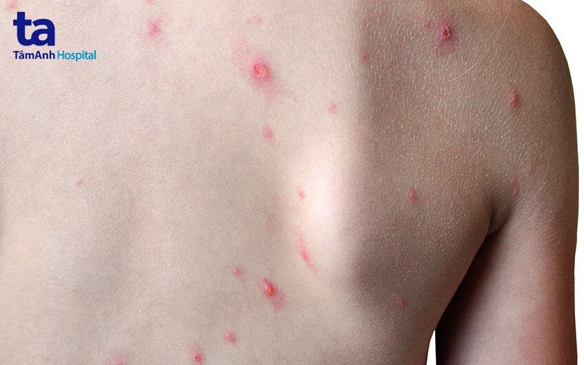 Bệnh đậu mùa khỉ lây lan qua những đường nào?
