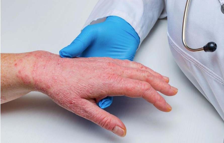 Lý do đậu mùa khỉ không gây lo lắng nhiều như Covid-19