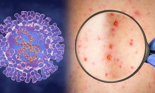 WHO: Bệnh đậu mùa khỉ không gây nguy cơ nghiêm trọng đối với y tế toàn cầu