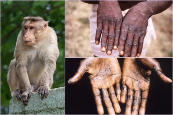 Mỹ xác định ca đầu tiên lây virus bệnh đậu mùa khỉ từ người sang người