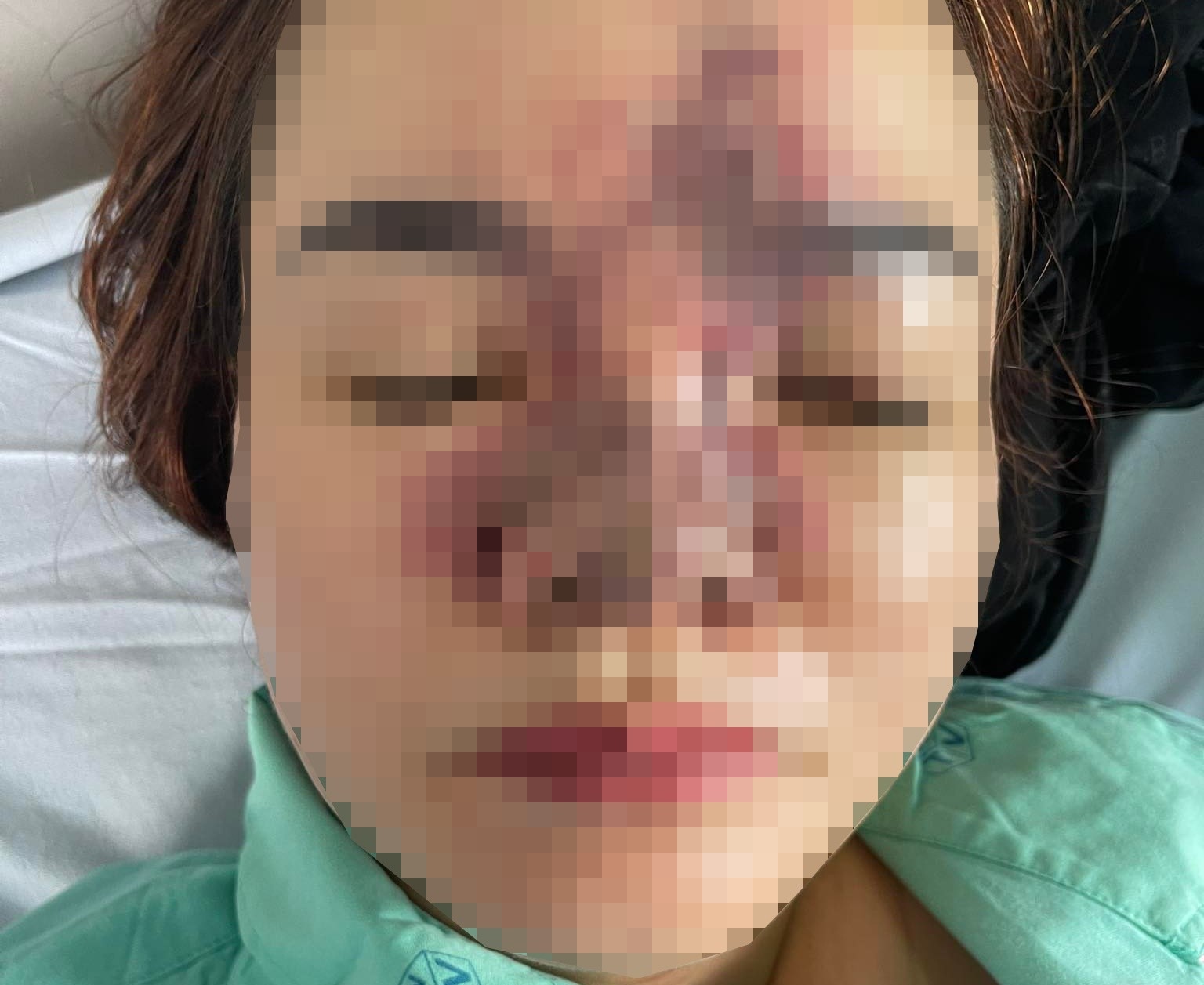 Tai biến thẩm mỹ khi đến spa làm đẹp, một phụ nữ bị hoại tử toàn bộ da mũi