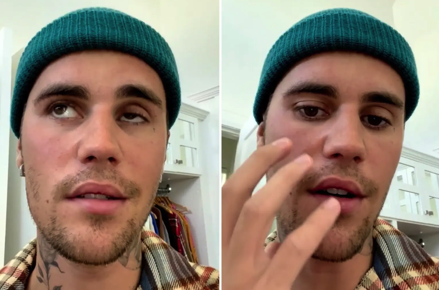 Hội chứng Ramsay Hunt khiến Justin Bieber liệt nửa mặt là gì?