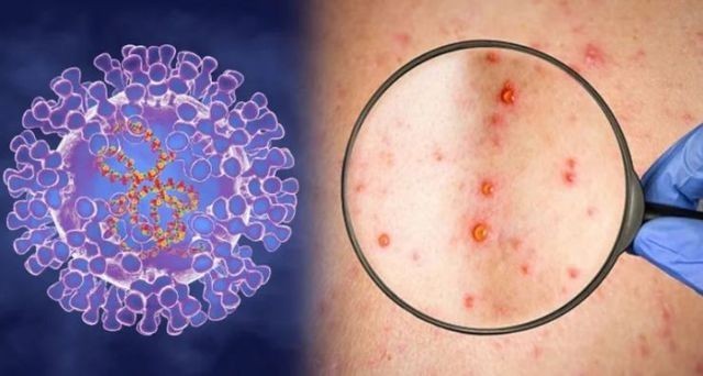 Bệnh đậu mùa khỉ lan nhanh trên thế giới, 6 khuyến cáo phòng bệnh