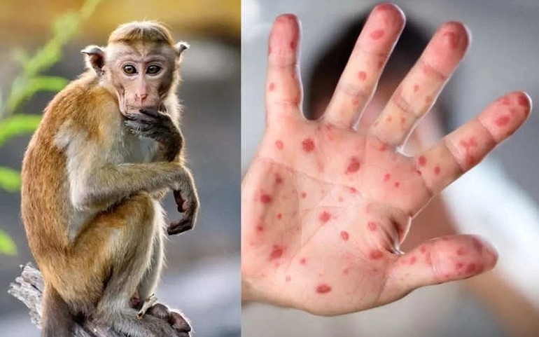 Thông tin mới nhất về ca bệnh đậu mùa khỉ đầu tiên tại Việt Nam