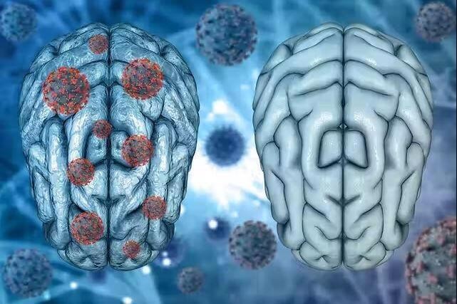 Covid-19 có thể gây viêm não tương tự bệnh Parkinson