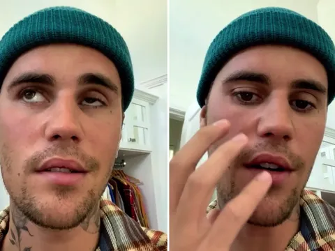 Hội chứng Ramsay Hunt khiến Justin Bieber liệt nửa mặt là gì?